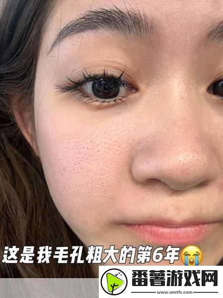 粗大黑头紫大黑头紫挤进-1.-粗大黑头紫的秘密：如何有效去除与护理