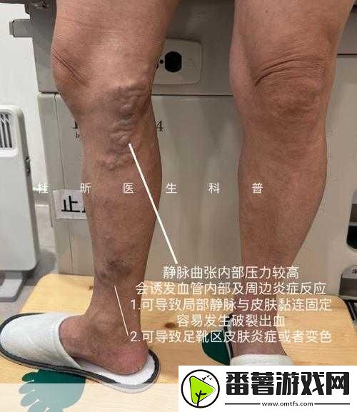 日系裸妆女士静脉曲张是什么得的-1.-日系裸妆技巧与静脉曲张的关系探究